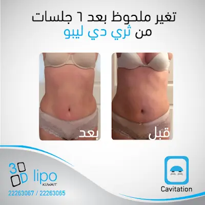 3d lipo kuwait clinic